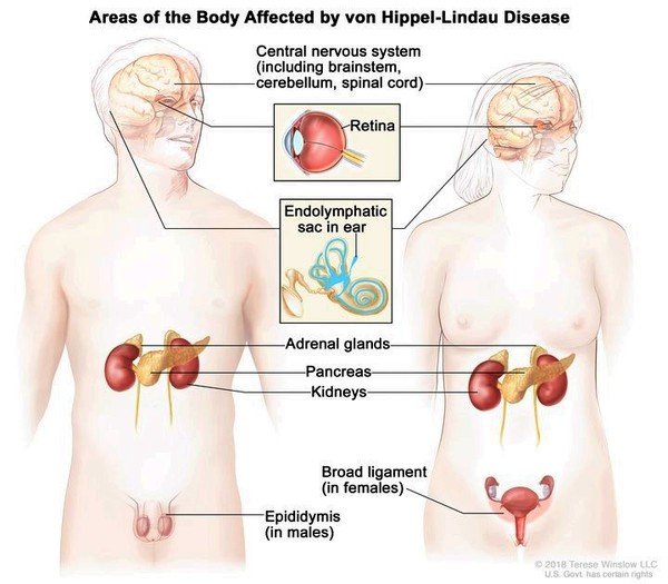 Merck 's Novel HIF-2α Inhibitor in patients with von Hippel-Lindau (VHL) Disease-Associated Clear Cell Renal Cell Carcinoma displayed an objective response rate of nearly 30%.
