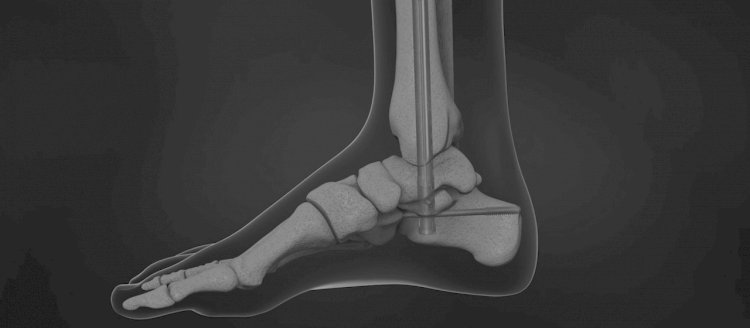 DJO acquired Trilliant Surgical, a global leader in foot and ankle orthopedic implants