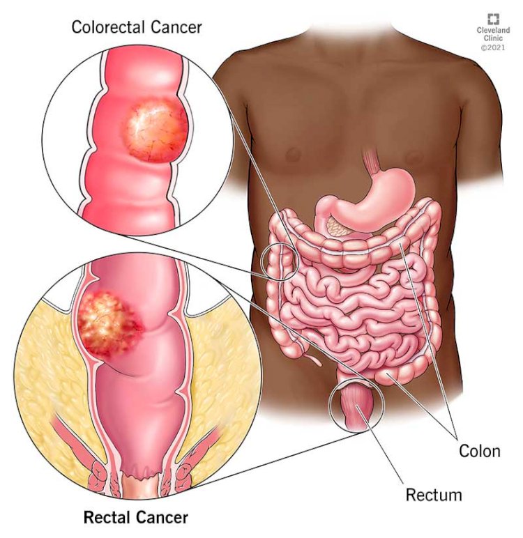 Colorectal Cancer Therapeutics Market Size Set to Cross USD 20.1 billion by 2028