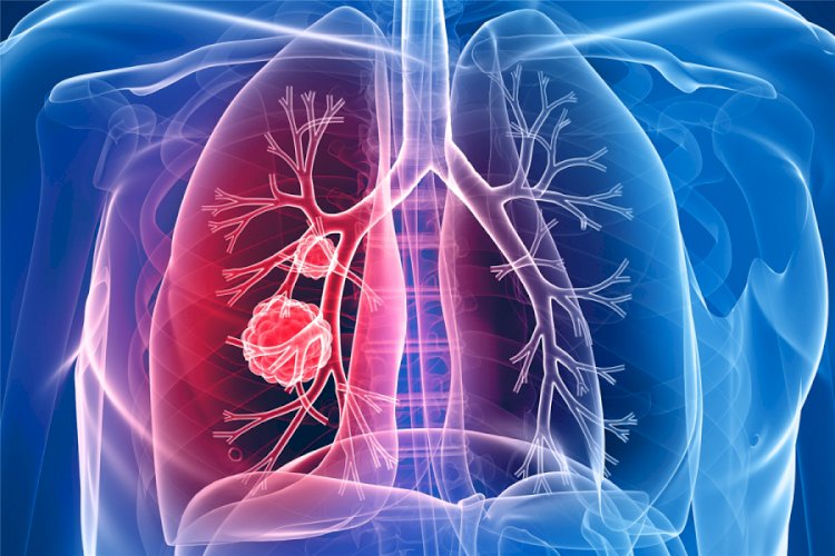 Lung Cancer Genomic Testing Medicine Market to Grow at a CAGR of 10.1% during Forecast Period