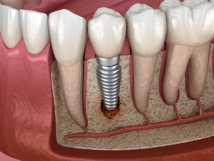 Global Peri-Implantitis Treatment Market to Expand at Steady CAGR of 8.1% During 2023–2029