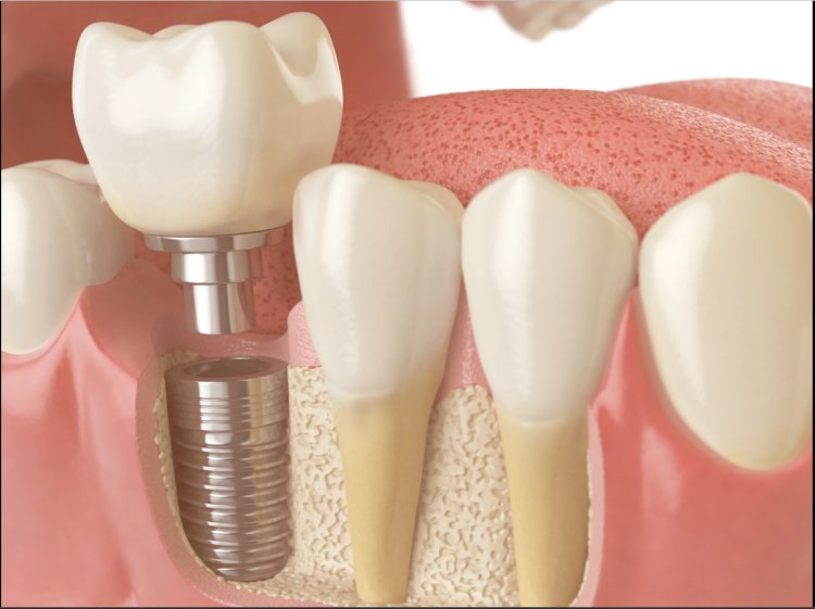 India Dental Bone Graft Substitute Market Size to Grow at Impressive CAGR of 8.3% During 2023–2029
